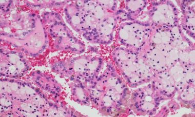 800-600-4-3-micrograph-of-renal-cell-carcinoma.jpg